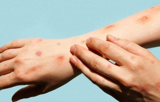 mpox